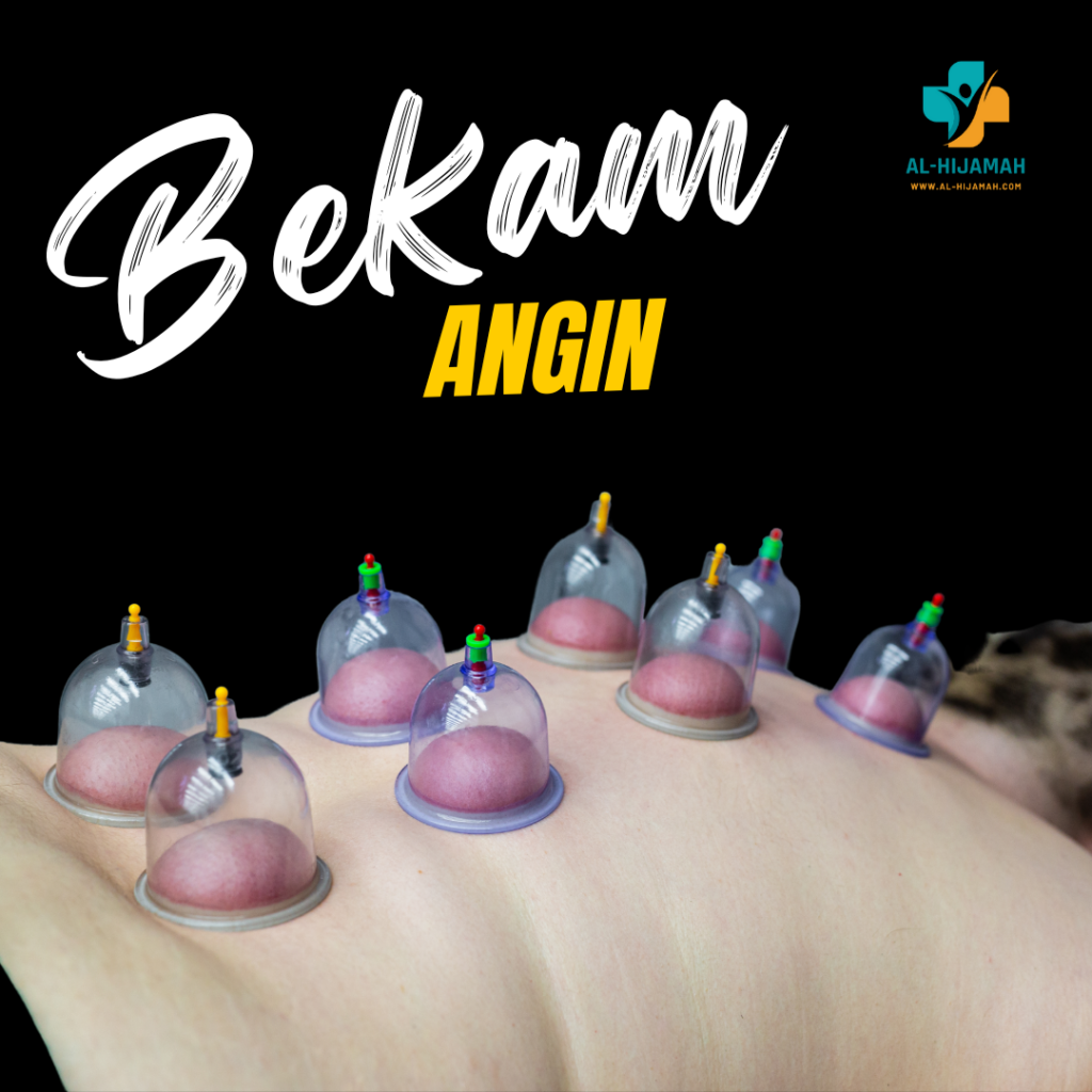 Bekam angin