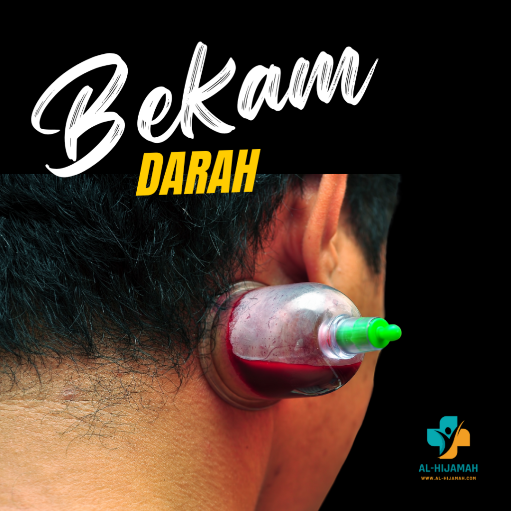 Bekam Darah