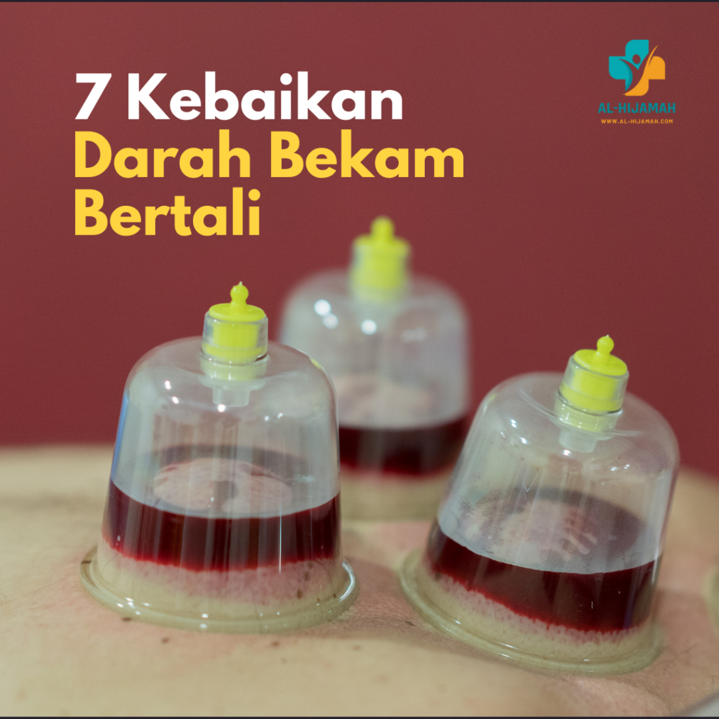 7 Kebaikan Darah Bekam Bertali