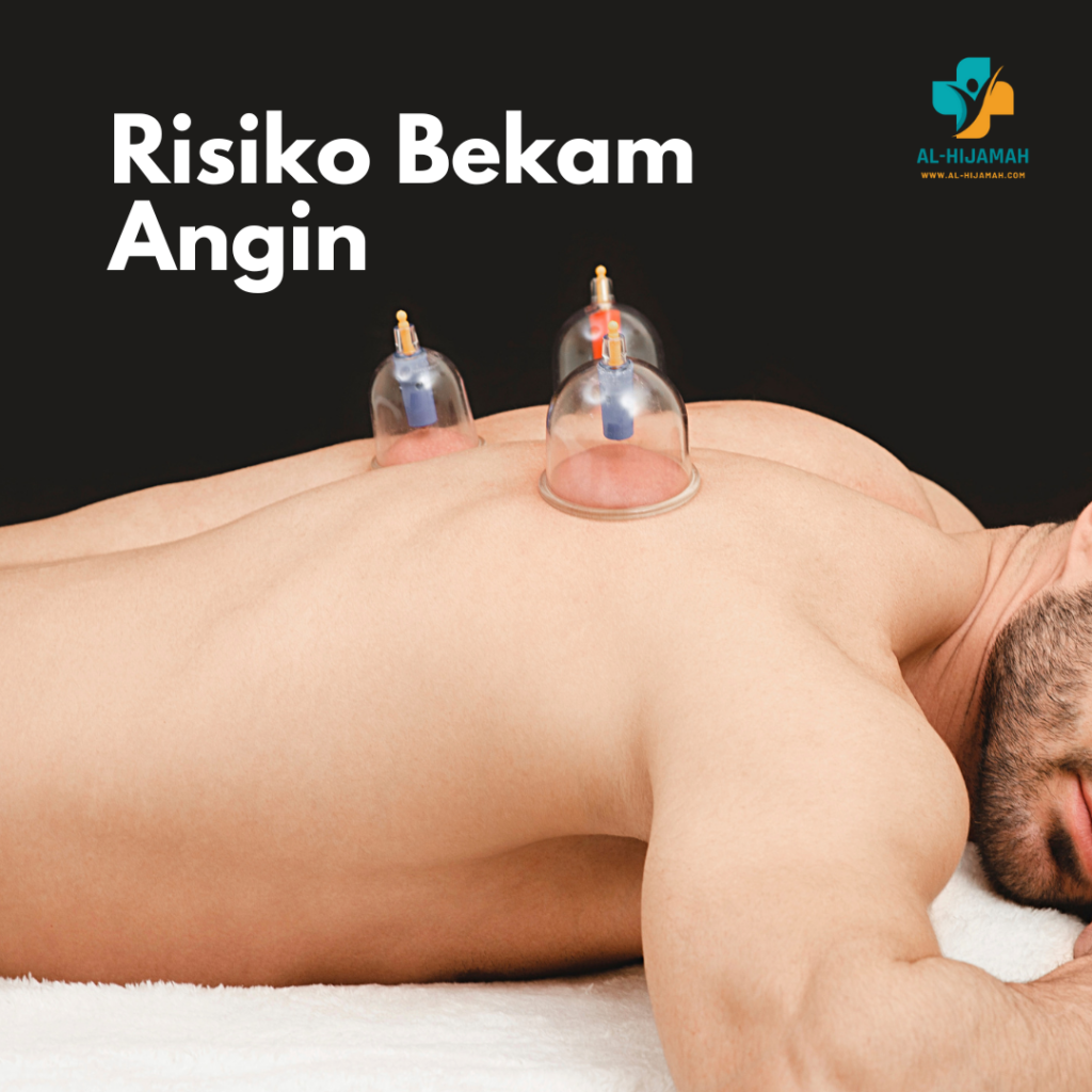 Risiko Bekam Angin